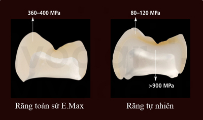 Độ sát khít răng của răng sứ thủy tinh Emax Press 1
