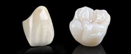 Độ sát khít răng của răng sứ thủy tinh Emax Press 2