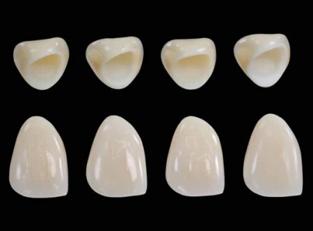 Độ sát khít răng của răng sứ thủy tinh Emax Press 5
