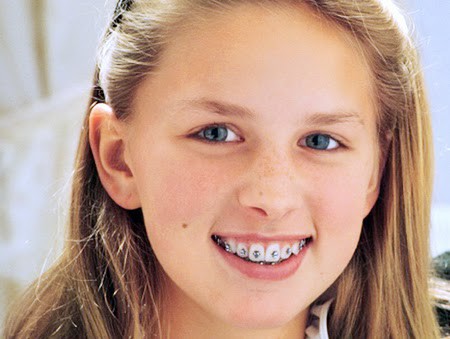Nên niềng răng hay phẫu thuật hàm khi trẻ hô răng