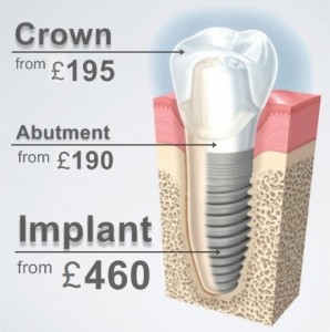 Tại sao cấy ghép Implant có chi phí khá cao ?