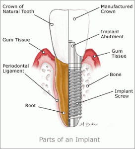 implant trong nha khoa