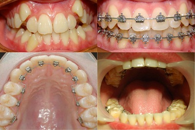 Niềng răng có ảnh hưởng gì không ?