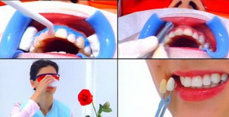 Những phương pháp tẩy trắng răng