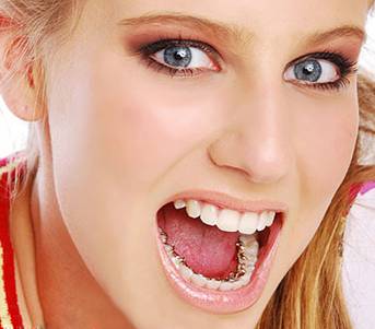 Các bước niềng răng mắc cài kim loại điều trị hô 4