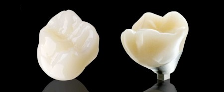 Răng sứ Venus có dễ nhiễm màu không 1