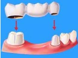 Bọc răng sứ để phục hình răng mòn mặt nhai 3