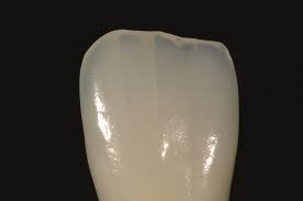 Độ sát khít răng của răng sứ thủy tinh Emax Press 4