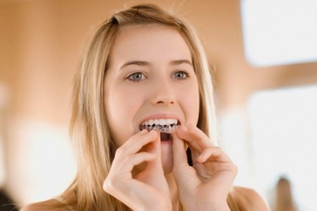 Niềng răng không mắc cài để điều trị răng mọc chen 4