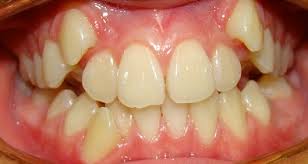 Niềng răng không mắc cài để điều trị răng mọc chen 1