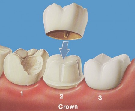 Mẻ răng nên làm gì 3