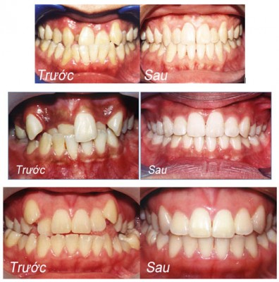 Vì sao răng bạn mọc lệch 1