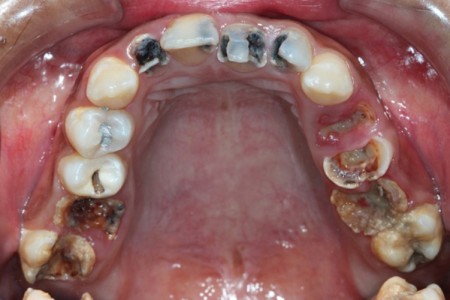 Quy trình chữa răng sâu 1