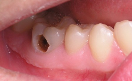 Triệu chứng và cách điều trị sâu răng 2