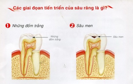 Triệu chứng và cách điều trị sâu răng 4
