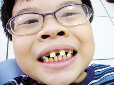 Triệu chứng và cách điều trị sâu răng 1