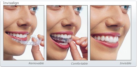 Đặc điểm của giải pháp niềng răng Invisalign1