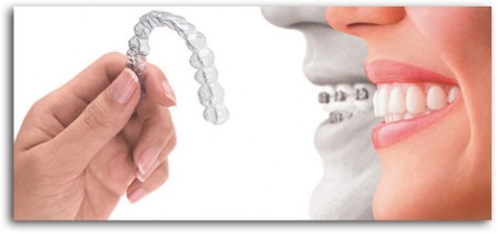 Đặc điểm của giải pháp niềng răng Invisalign 3