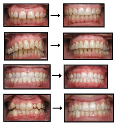 Mỗi khay Invisalign di chuyển răng được bao nhiêu 2