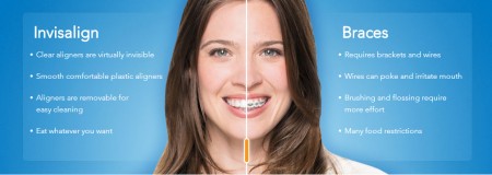 Mỗi khay Invisalign di chuyển răng được bao nhiêu 4