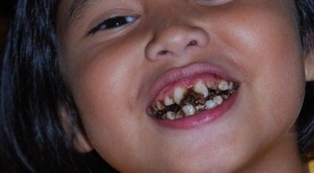 Hiện tượng sâu răng sữa ở trẻ 1