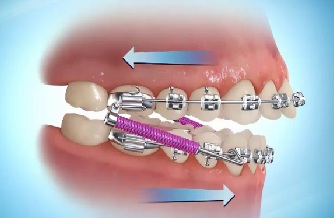 Tìm hiểu về khí cụ duy trì trong niềng răng 4