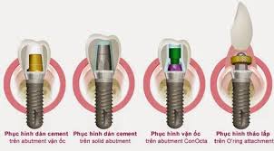 Những câu hỏi về implant