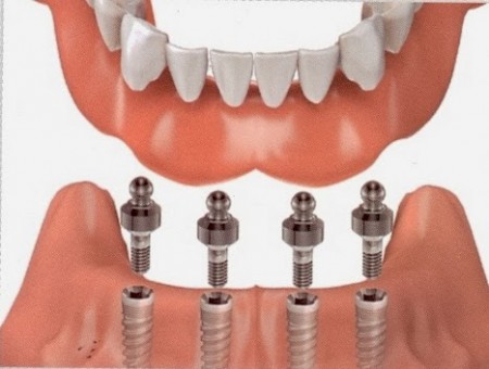 Có nên cấy ghép Implant sau khi nhổ răng 2