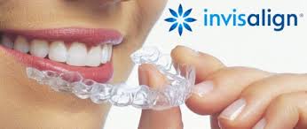 Niềng răng không mắc cài invisalign