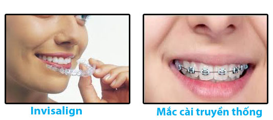 Niềng răng không mắc cài invisalign