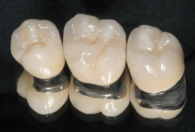 Phương pháp bọc răng sứ titan