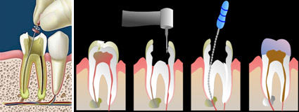 Làm sao hạn chế lấy tủy trong điều trị răng sâu 