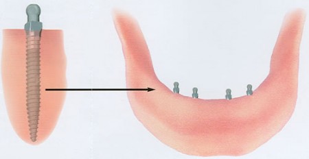 cay-ghep-implant-co-gay-hai-gi-khong-2