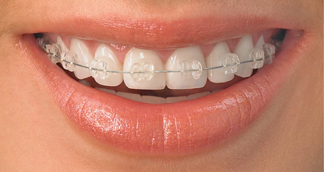 Hai phương pháp chính trong niềng răng