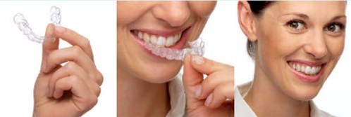 Nụ cười đẹp hơn với phương pháp niềng răng invisalign