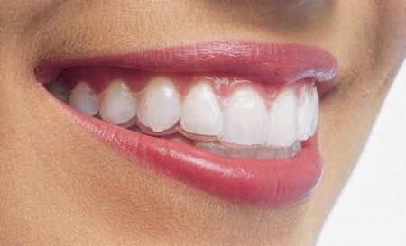 Nụ cười đẹp hơn với phương pháp niềng răng invisalign