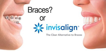 Nụ cười đẹp hơn với phương pháp niềng răng invisalign