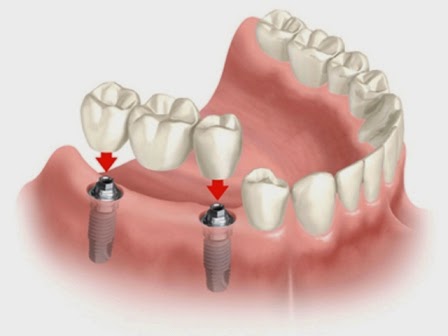 Cách duy trì chức năng ăn nhai sau khi mất răng