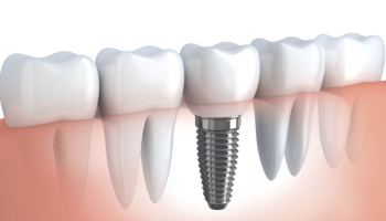 Chi phí cấy ghép implant nha khoa