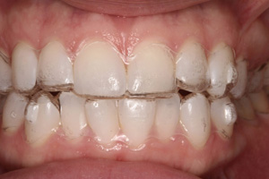 Invisalign - Niềng răng không nhổ răng