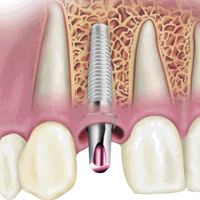 Nhổ răng sâu có ảnh hưởng sức khỏe không?