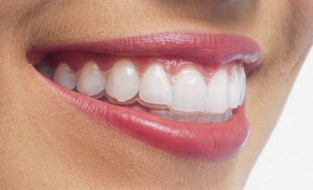 Những điểm lợi ích khi niềng răng invisalign