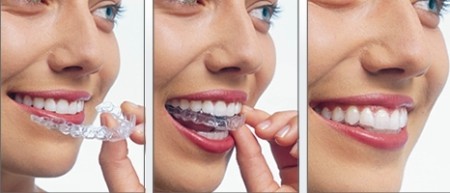 Những điểm lợi ích khi niềng răng invisalign