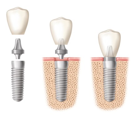 Tìm hiểu vật liệu dùng cấy ghép răng implant