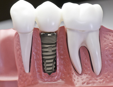 Tìm hiểu vật liệu dùng cấy ghép răng implant