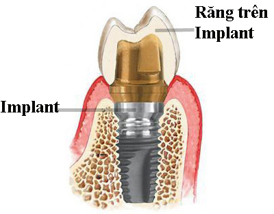 Tuổi thọ của răng giả implant được lâu không?