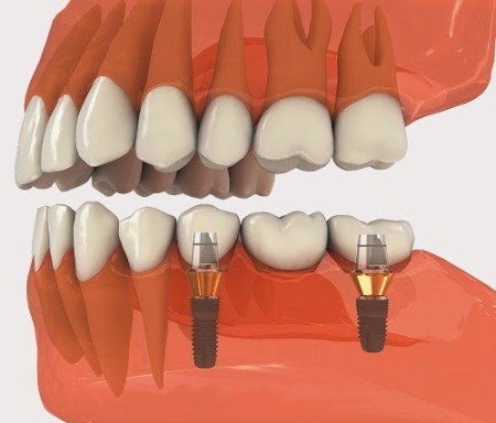 Tuổi thọ của răng giả implant được lâu không?