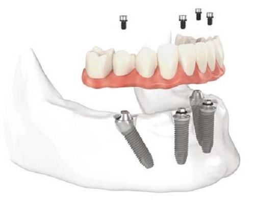 Cấy ghép implant sự lựa chọn thay thế răng bị mất