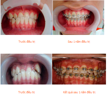 Chi phí cải thiện khớp cắn lệch