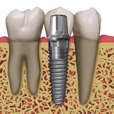 Chọn thời điểm thích hợp để cấy ghép implant